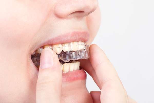 Things You May Not Have Known About Clear Braces