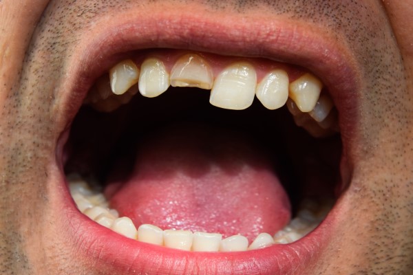 How A General Dentist Can Treat A Chipped Tooth