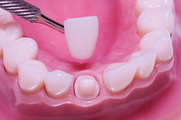 How Long Will A Dental Crown Last?