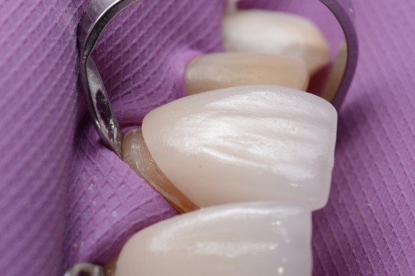 A Dental Veneer &#    ; Solution For A Broken Tooth