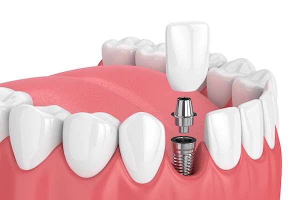 How Painful is Dental Implant Surgery from Sylmar Dental & Braces in Los Angeles, CA