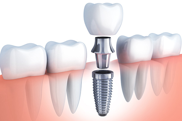 Questions to Ask Your Implant Dentist from Sylmar Dental & Braces in Los Angeles, CA