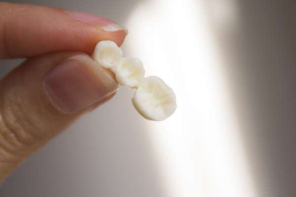 Replace Missing Teeth with Dental Bridges from Sylmar Dental & Braces in Los Angeles, CA