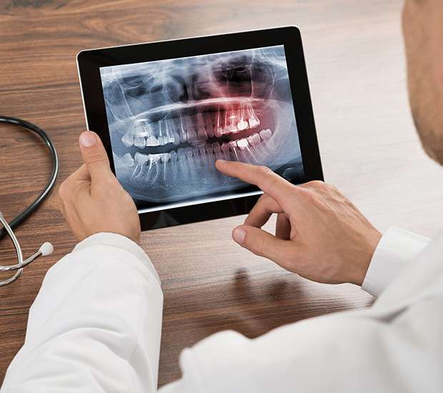 Los Angeles Types of Dental Root Fractures